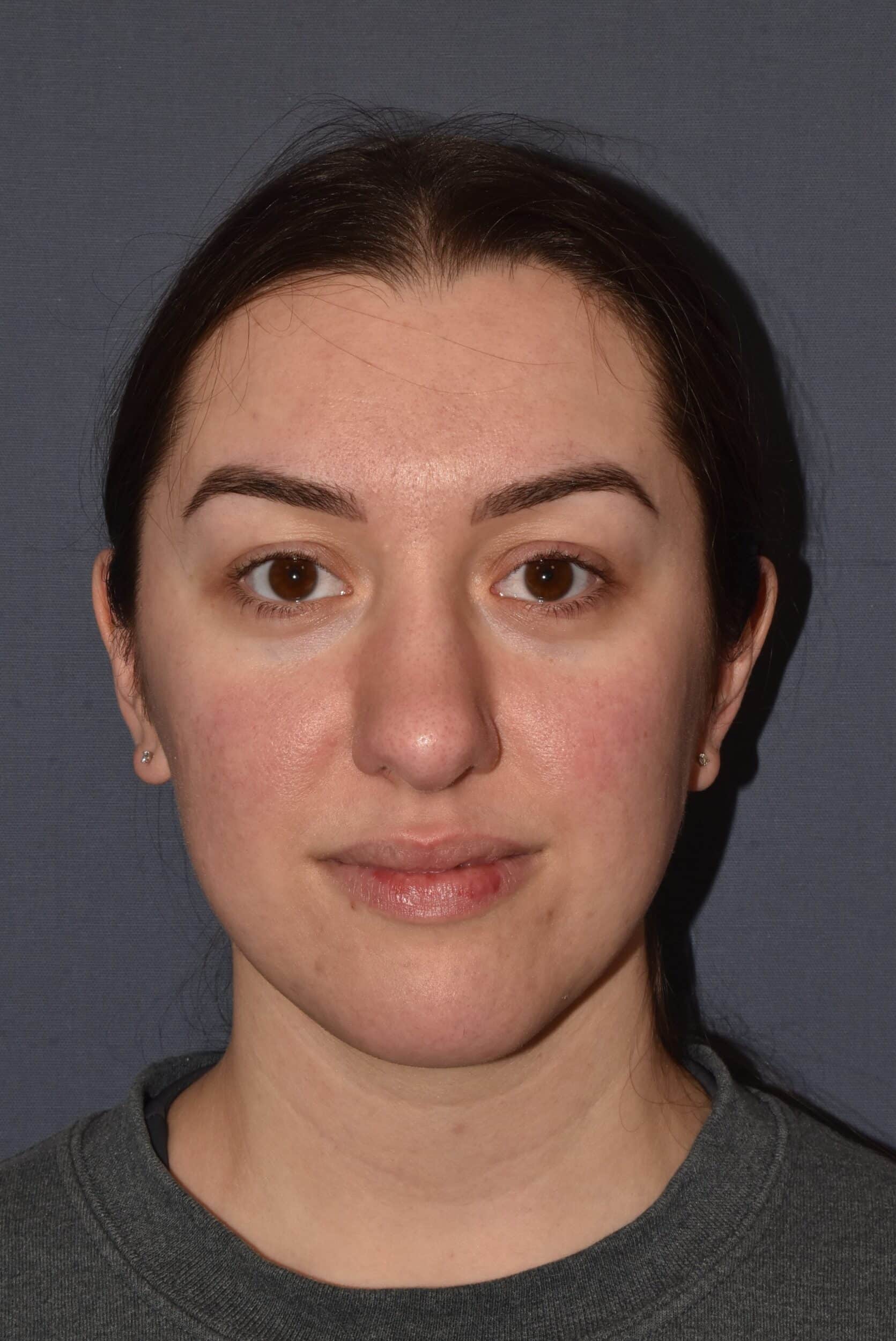 Before Image: Rhinoplasty – Open - front