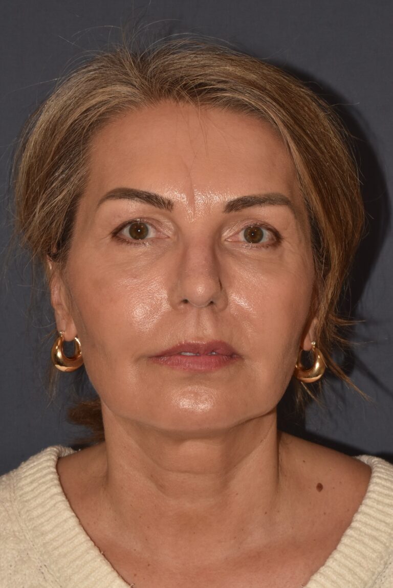 After Image: Rhinoplasty – Open - front