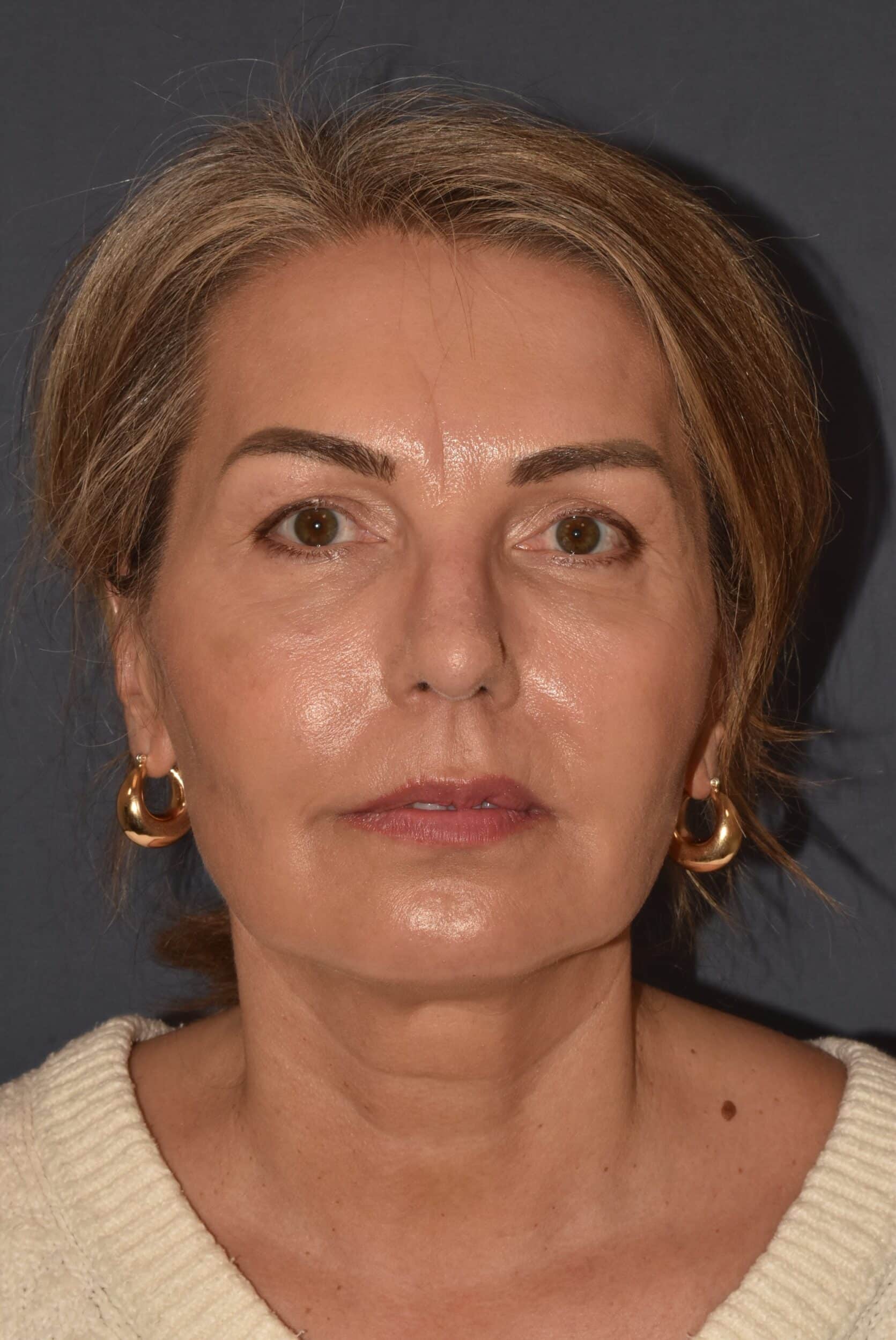 After Image: Rhinoplasty – Open - front