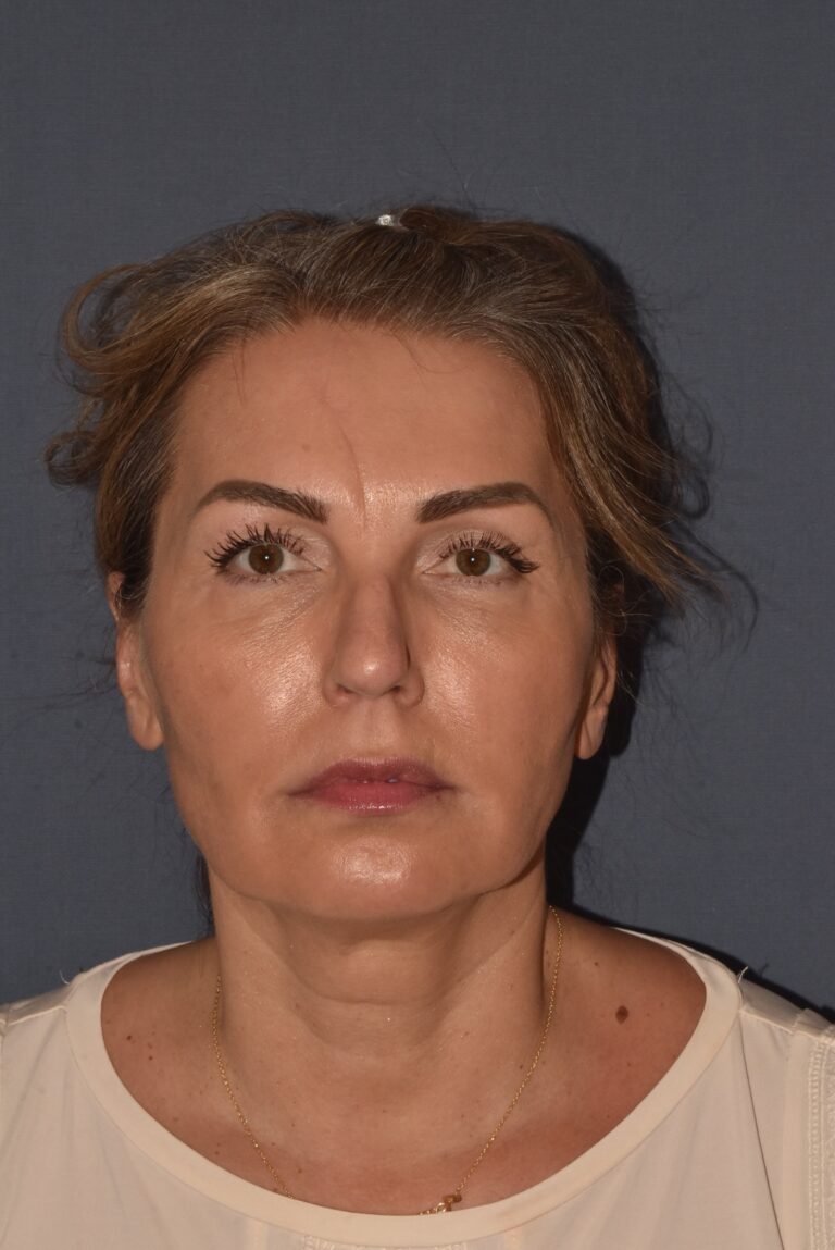 Before Image: Rhinoplasty – Open - front