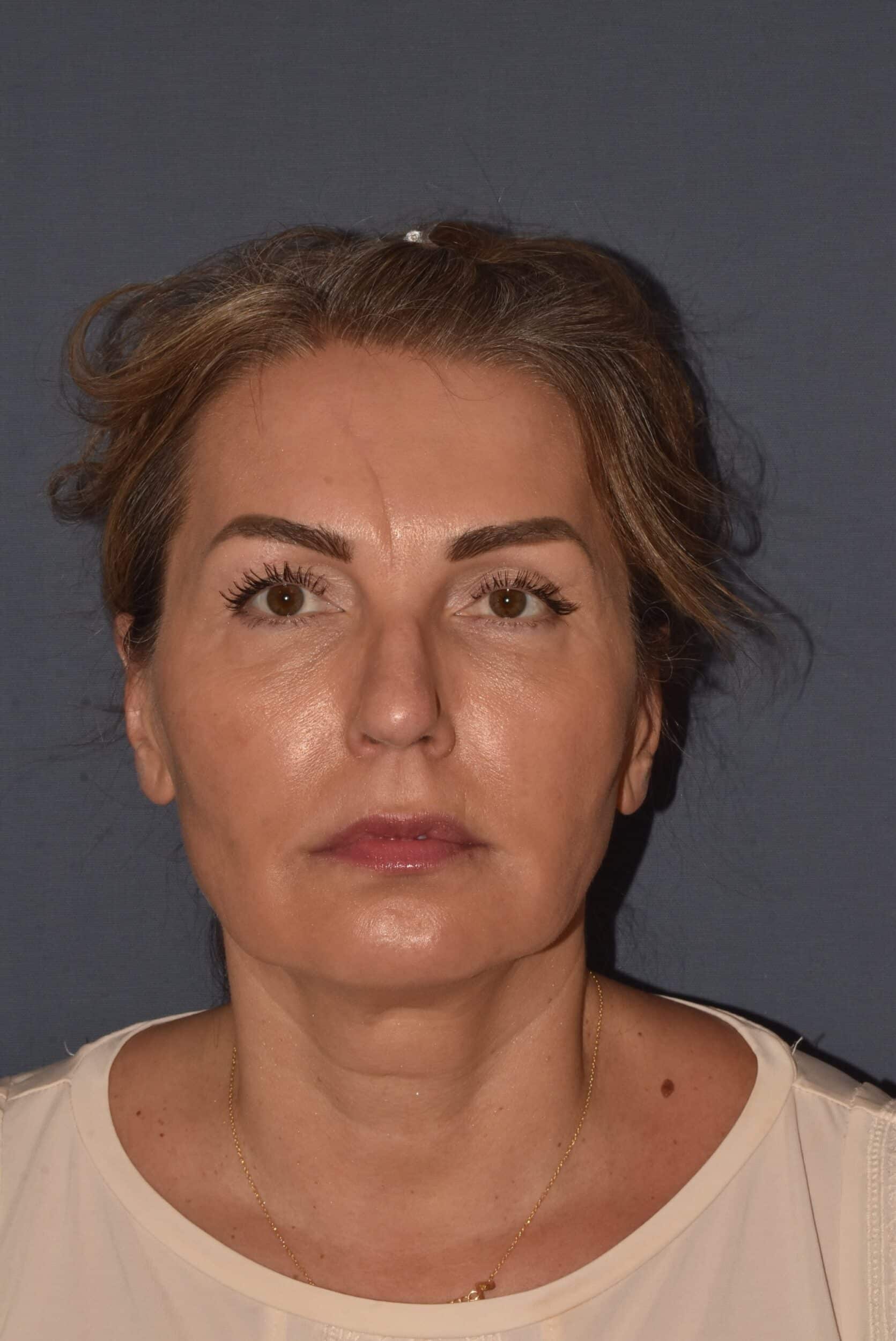 Before Image: Rhinoplasty – Open - front