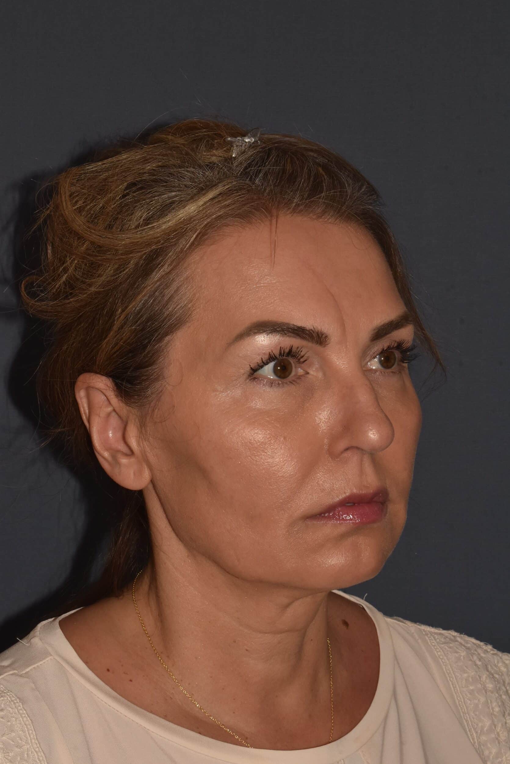 Before Image: Rhinoplasty – Open - right-front-oblique