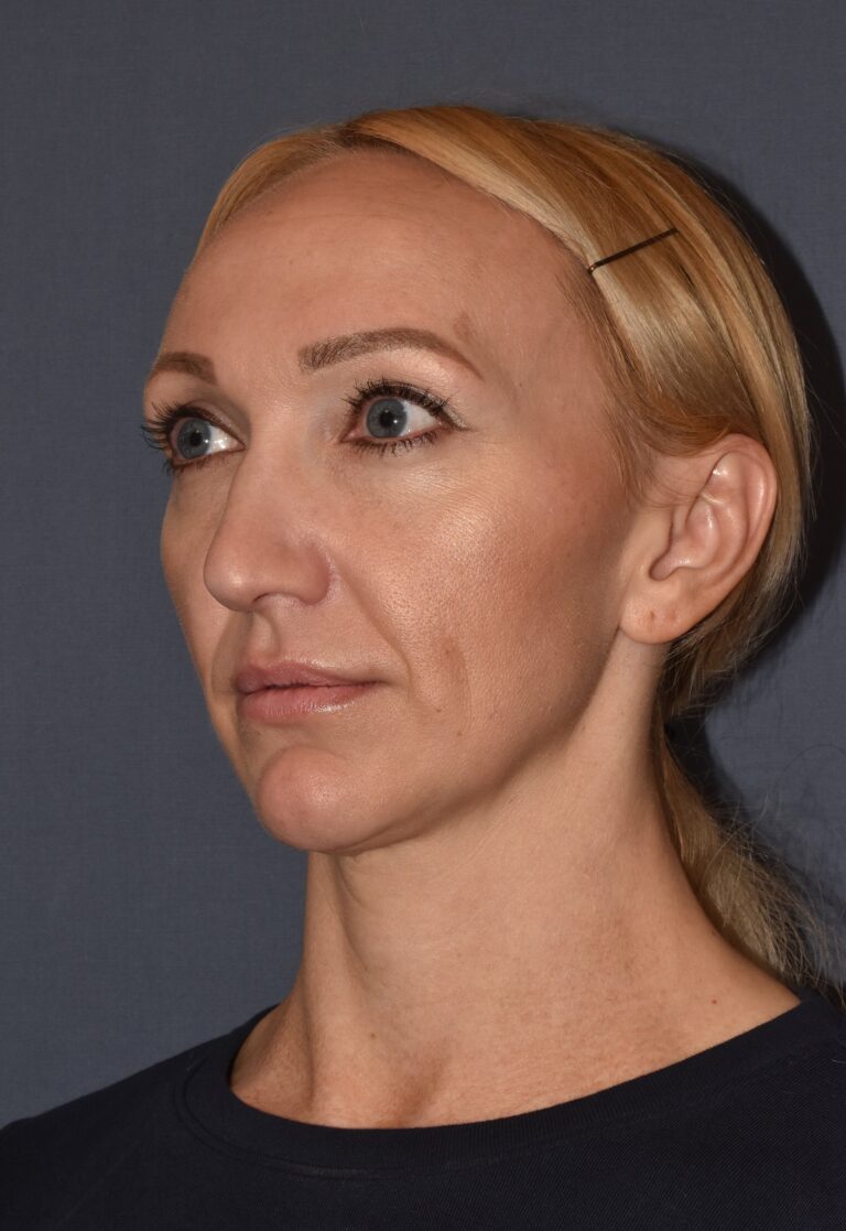 Before Image: Rhinoplasty – Open with Airway Improvement - left-front-oblique