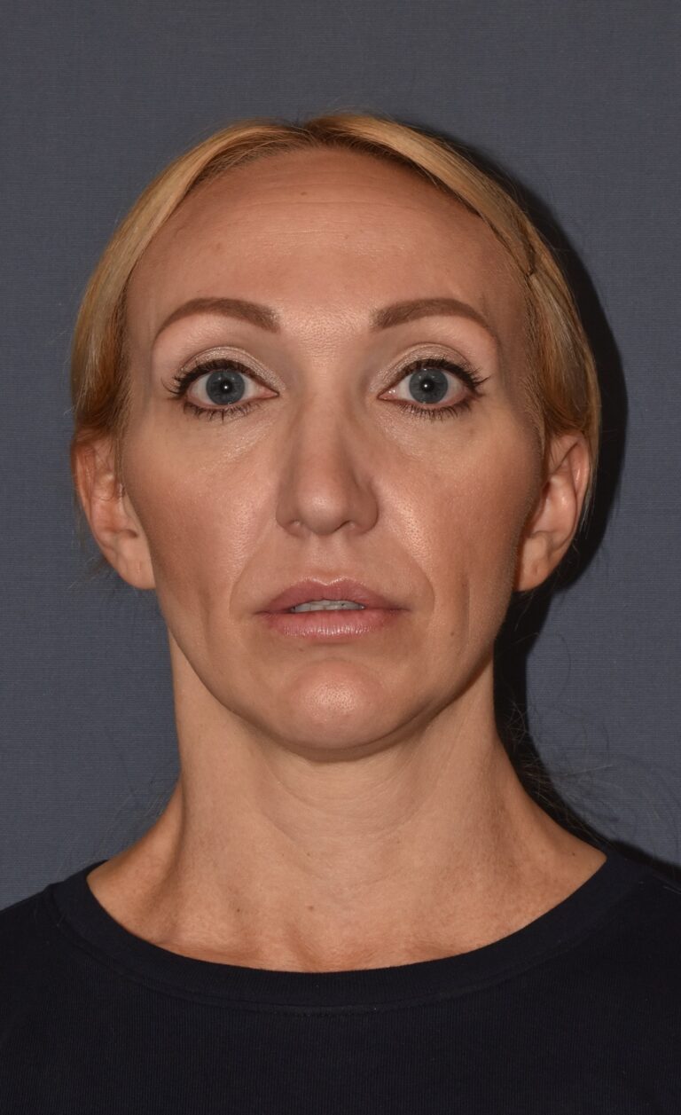 Before Image: Rhinoplasty – Open with Airway Improvement - front