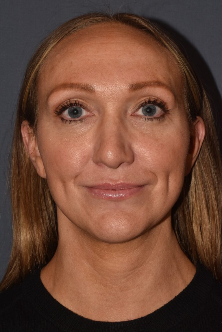 After Image: Rhinoplasty – Open with Airway Improvement - front