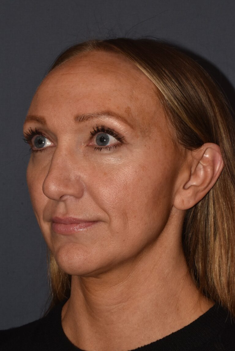 After Image: Rhinoplasty – Open with Airway Improvement - left-front-oblique