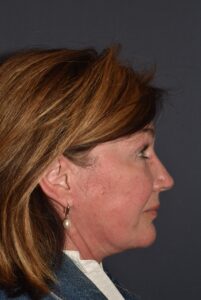 After Image: Facial Rejuvenation – Necklift Redo with Browlift and Chin Implant