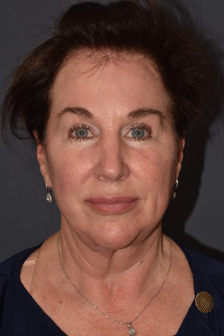 Before Image: Facial Rejuvenation – Necklift Redo with Browlift and Chin Implant - front