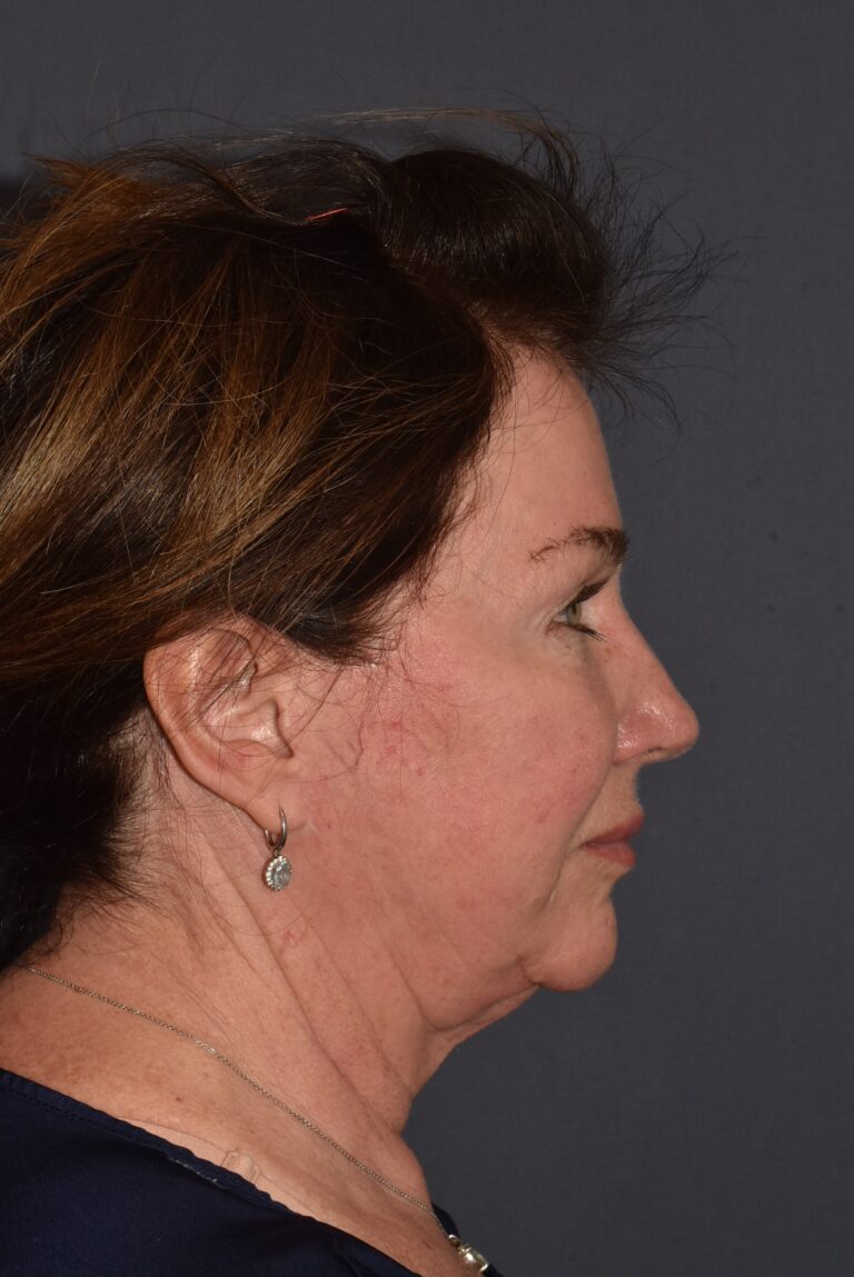 Before Image: Facial Rejuvenation – Necklift Redo with Browlift and Chin Implant - right-side