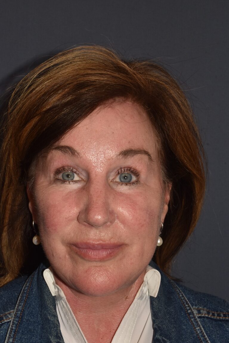 After Image: Facial Rejuvenation – Necklift Redo with Browlift and Chin Implant - front