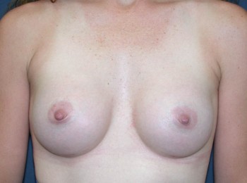 After Image: Breast Augmentation After Pregnancy Volume Loss - front