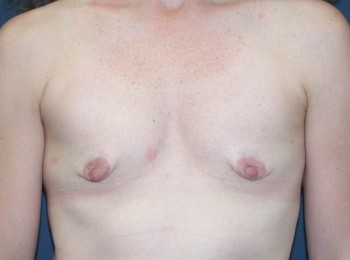 Before Image: Breast Augmentation After Pregnancy Volume Loss - front