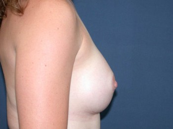 After Image: Breast Augmentation After Pregnancy Volume Loss - other