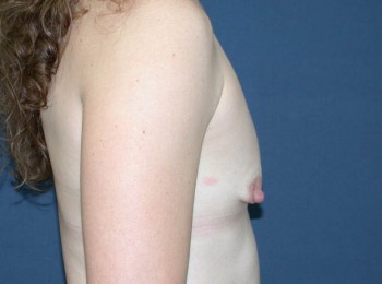 Before Image: Breast Augmentation After Pregnancy Volume Loss - other