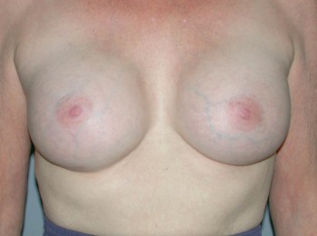 After Image: Breast Augmentation After Pregnancy Volume Loss - front