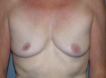 Before Image: Breast Augmentation After Pregnancy Volume Loss - front