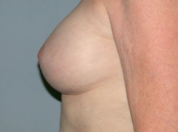 Breast Augmentation After Pregnancy Volume Loss