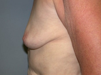 Breast Augmentation After Pregnancy Volume Loss