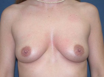Before Image: Breast Augmentation Dense Breasts - front