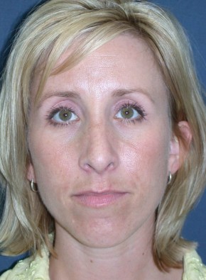 Rhinoplasty – Closed