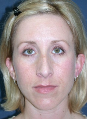 Rhinoplasty – Closed