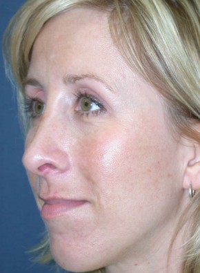 Rhinoplasty – Closed