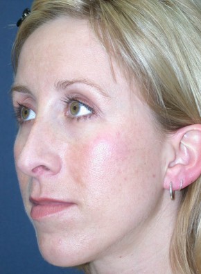 Rhinoplasty – Closed