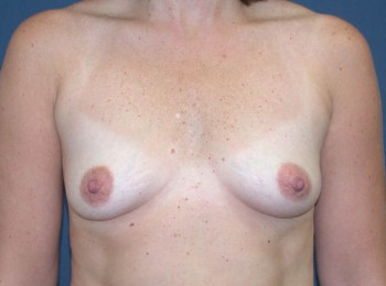 Before Image: Breast Augmentation Ptotic (Sagging) Breasts - front