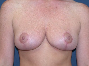After Image: Mastopexy