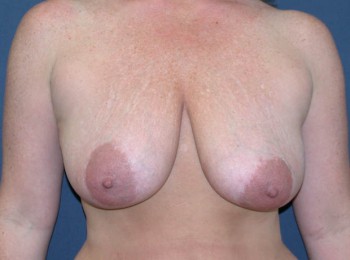 Before Image: Mastopexy