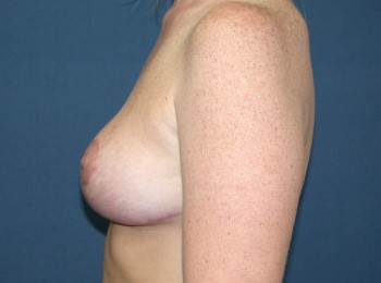 After Image: Mastopexy - other