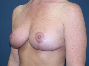 After Image: Mastopexy - other