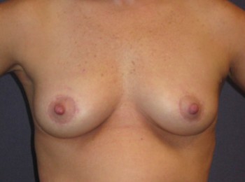 After Image: Mastopexy - front