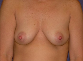 Before Image: Mastopexy - front