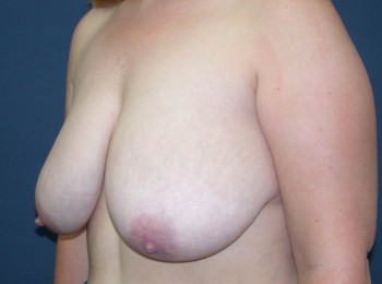 Before Image: Mastopexy - other