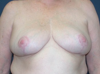 After Image: Mastopexy - front
