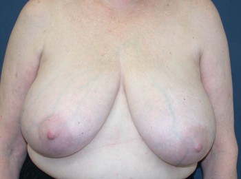 Before Image: Mastopexy - front