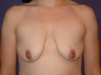 Before Image: Mommy Makeover 2 – Breast Augmentation Mastopexy - front