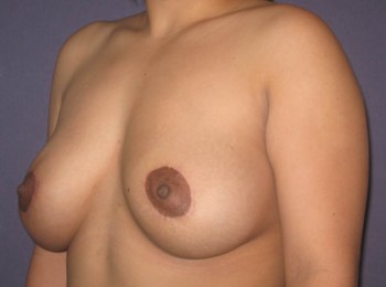 Mommy Makeover 1 – Breast Augmentation Mastopexy
