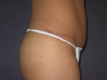 Mommy Makeover 1 – Abdominoplasty