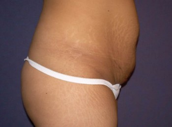 Mommy Makeover 1 – Abdominoplasty