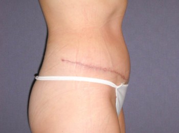 Abdominoplasty