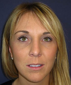 Rhinoplasty – Closed