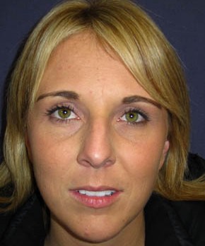 Rhinoplasty – Closed
