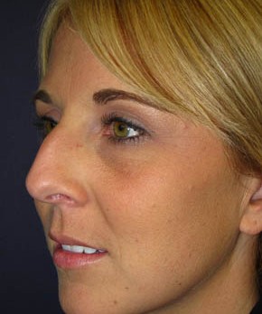 Rhinoplasty – Closed