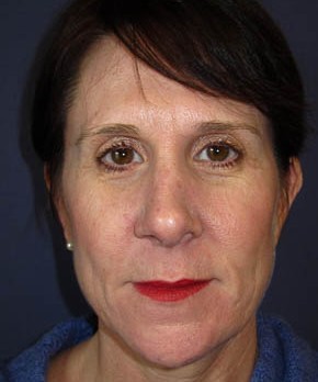 Rhinoplasty – Open