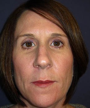 Rhinoplasty – Open
