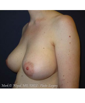 Breast Augmentation Revision