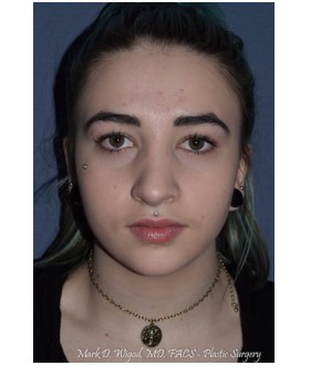 Rhinoplasty – Open