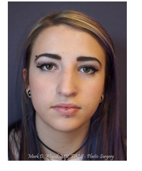 Rhinoplasty – Open